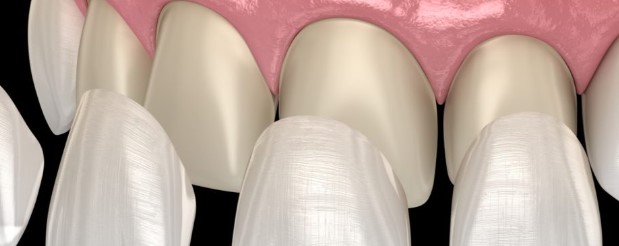 The Longevity of Dental Veneers: What to Expect and How to Maintain Them