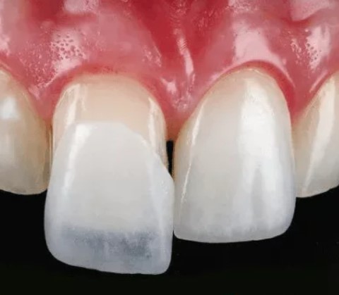 The Longevity Of Dental Veneers What To Expect And How To Maintain Them, durability, lifespan, veneer care, dental beauty, dental investment, preserving brilliance, oral hygiene, dental checkups, expert guidance, radiant smile, veneer maintenance, veneer replacement, lasting results, veneer durability, maintaining veneers, veneer lifespan, dental procedures, dental health, dental treatments, veneer expectations, veneer maintenance tips, veneer aftercare, dental tips, veneer advice